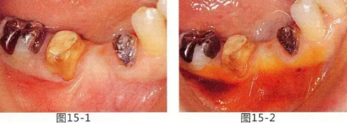 FGG法增大附著齦及根面覆蓋【牙齦-牙槽黏膜的問題】.png FGG法增大附著齦及根面覆蓋【牙齦-牙槽黏膜的問題】.png