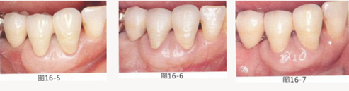 FGG法增大附著齦及根面覆蓋【牙齦-牙槽黏膜的問題】.png FGG法增大附著齦及根面覆蓋【牙齦-牙槽黏膜的問題】.png
