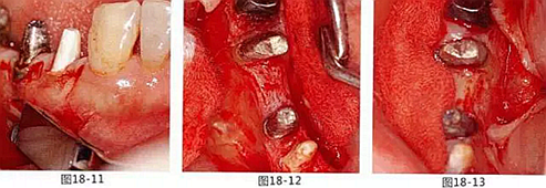 FGG法增大附著齦及根面覆蓋【牙齦-牙槽黏膜的問題】.png FGG法增大附著齦及根面覆蓋【牙齦-牙槽黏膜的問題】.png