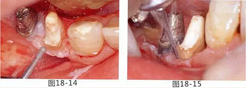 FGG法增大附著齦及根面覆蓋【牙齦-牙槽黏膜的問題】.png FGG法增大附著齦及根面覆蓋【牙齦-牙槽黏膜的問題】.png