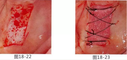 FGG法增大附著齦及根面覆蓋【牙齦-牙槽黏膜的問題】.png FGG法增大附著齦及根面覆蓋【牙齦-牙槽黏膜的問題】.png