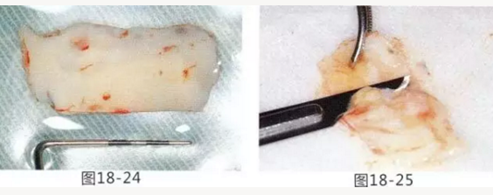 FGG法增大附著齦及根面覆蓋【牙齦-牙槽黏膜的問題】.png FGG法增大附著齦及根面覆蓋【牙齦-牙槽黏膜的問題】.png