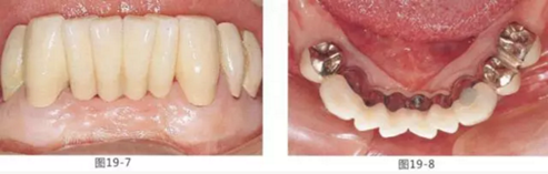 FGG法增大附著齦及根面覆蓋【牙齦-牙槽黏膜的問題】.png FGG法增大附著齦及根面覆蓋【牙齦-牙槽黏膜的問題】.png