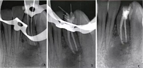 下頜側(cè)切牙Ⅲ型牙內(nèi)陷1例.png 下頜側(cè)切牙Ⅲ型牙內(nèi)陷1例.png