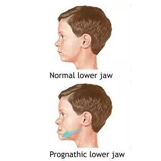 “地包天”的最佳治療時(shí)間 “地包天”的最佳治療時(shí)間