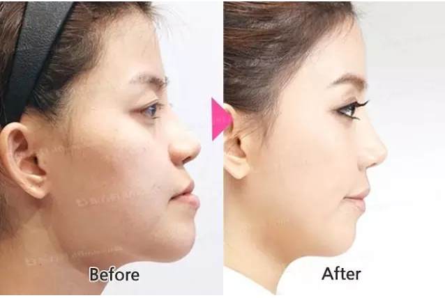 “地包天”的最佳治療時(shí)間 “地包天”的最佳治療時(shí)間