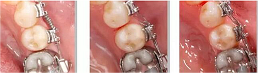 宇森正畸鄰面套裝 宇森正畸鄰面套裝