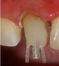 纖維樁臨床操作步驟 纖維樁臨床操作步驟