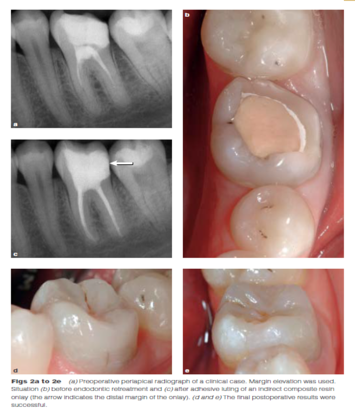 DME: 齦壁提升術(shù) DME: 齦壁提升術(shù)