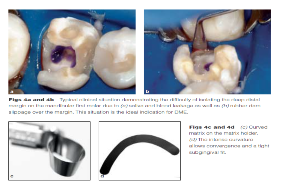 DME: 齦壁提升術(shù) DME: 齦壁提升術(shù)