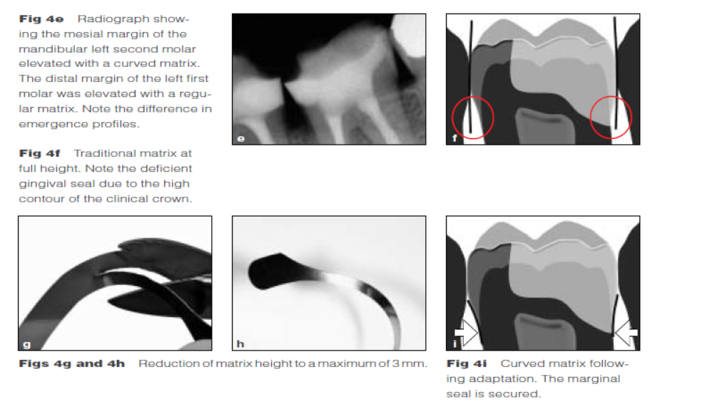 DME: 齦壁提升術(shù) DME: 齦壁提升術(shù)
