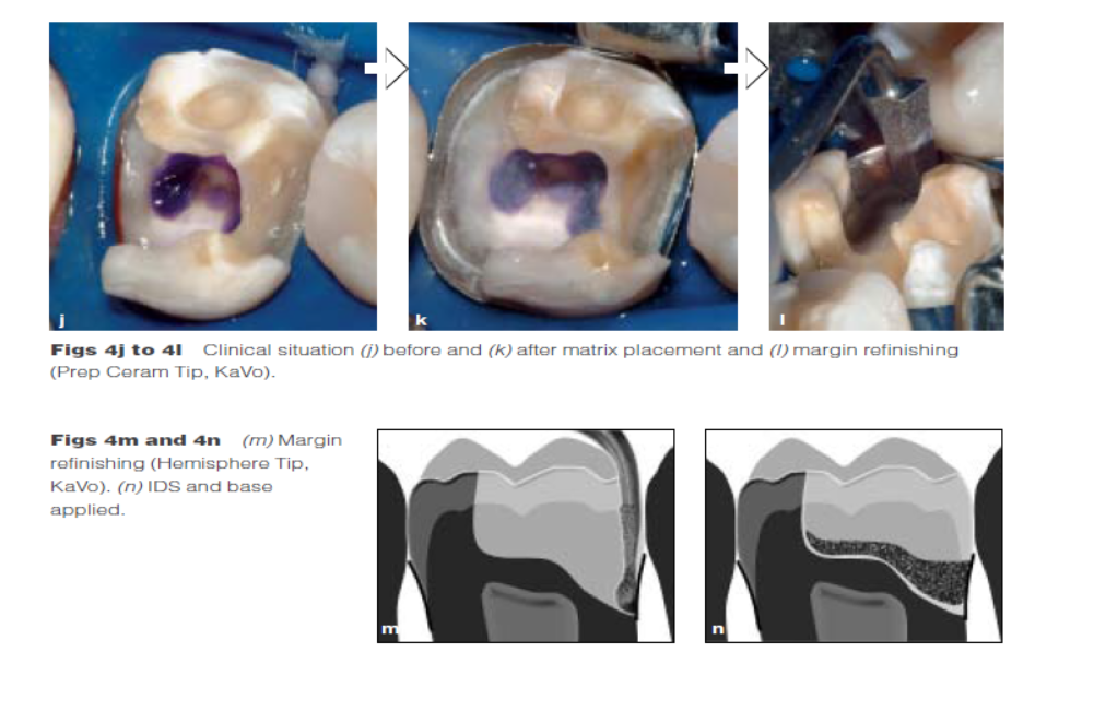 DME: 齦壁提升術(shù) DME: 齦壁提升術(shù)
