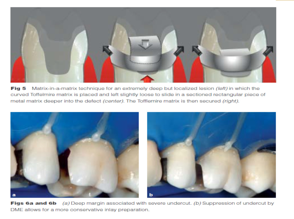 DME: 齦壁提升術(shù) DME: 齦壁提升術(shù)