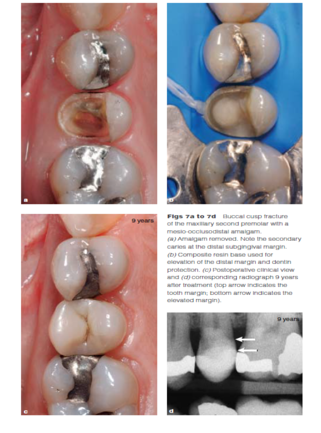 DME: 齦壁提升術(shù) DME: 齦壁提升術(shù)