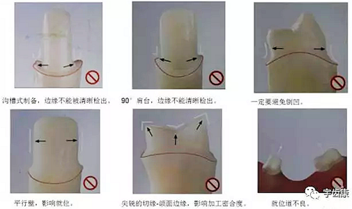 影響全瓷牙冠裂的因素有哪些？