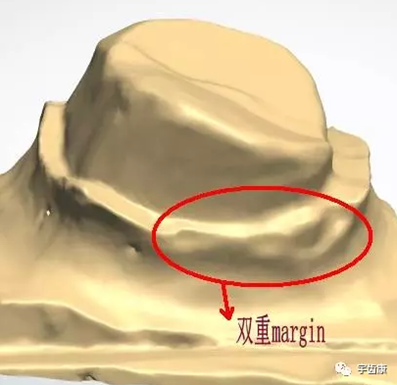 影響全瓷牙冠裂的因素有哪些？