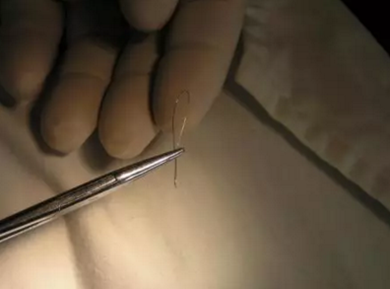 弓絲結(jié)扎及扎絲末端處理技巧 弓絲結(jié)扎及扎絲末端處理技巧