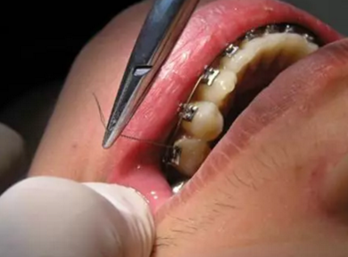 弓絲結(jié)扎及扎絲末端處理技巧 弓絲結(jié)扎及扎絲末端處理技巧