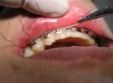 弓絲結(jié)扎及扎絲末端處理技巧 弓絲結(jié)扎及扎絲末端處理技巧