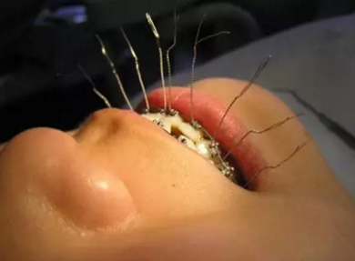 弓絲結(jié)扎及扎絲末端處理技巧 弓絲結(jié)扎及扎絲末端處理技巧