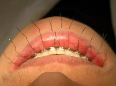 弓絲結(jié)扎及扎絲末端處理技巧 弓絲結(jié)扎及扎絲末端處理技巧