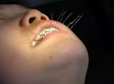 弓絲結(jié)扎及扎絲末端處理技巧 弓絲結(jié)扎及扎絲末端處理技巧