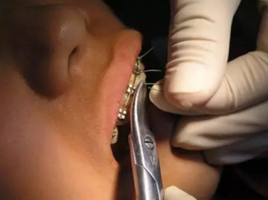 弓絲結(jié)扎及扎絲末端處理技巧 弓絲結(jié)扎及扎絲末端處理技巧