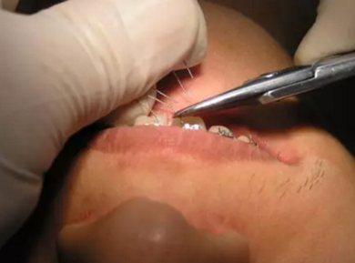 弓絲結(jié)扎及扎絲末端處理技巧 弓絲結(jié)扎及扎絲末端處理技巧