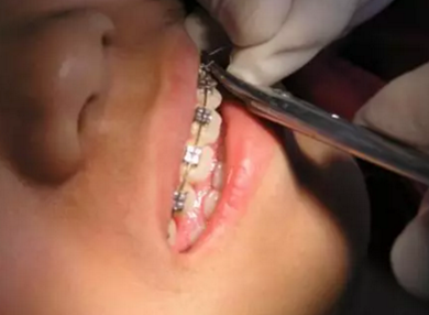 弓絲結(jié)扎及扎絲末端處理技巧 弓絲結(jié)扎及扎絲末端處理技巧