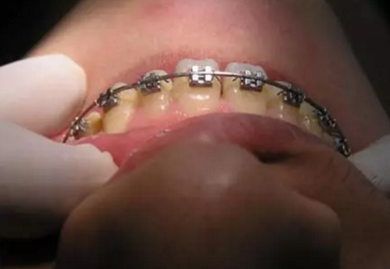 弓絲結(jié)扎及扎絲末端處理技巧 弓絲結(jié)扎及扎絲末端處理技巧