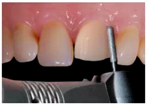 全瓷修復體貼面的制備 全瓷修復體貼面的制備