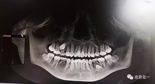 微創(chuàng)舒適拔埋伏牙病 微創(chuàng)舒適拔埋伏牙病