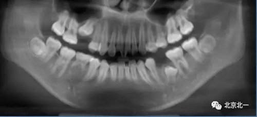 微創(chuàng)舒適拔埋伏牙病 微創(chuàng)舒適拔埋伏牙病