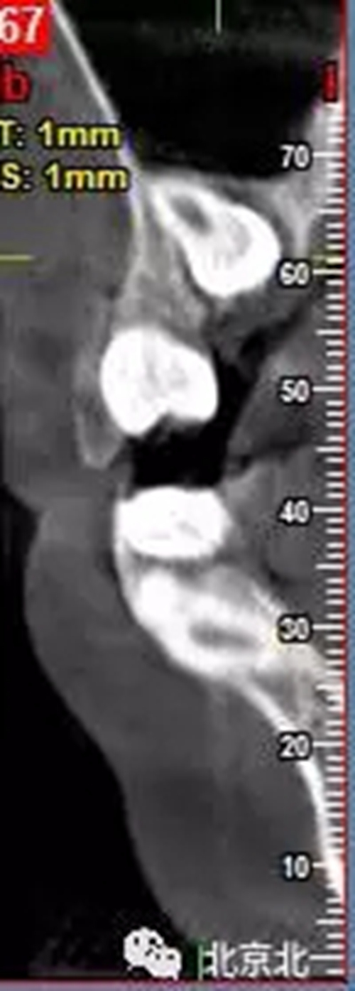 微創(chuàng)舒適拔埋伏牙病 微創(chuàng)舒適拔埋伏牙病