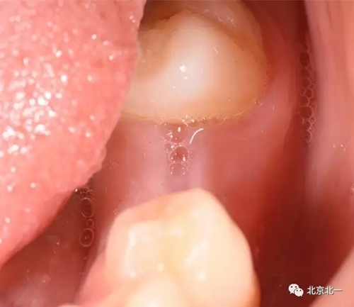 微創(chuàng)舒適拔埋伏牙病 微創(chuàng)舒適拔埋伏牙病