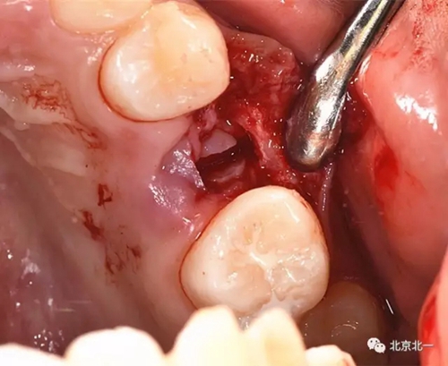 微創(chuàng)舒適拔埋伏牙病 微創(chuàng)舒適拔埋伏牙病