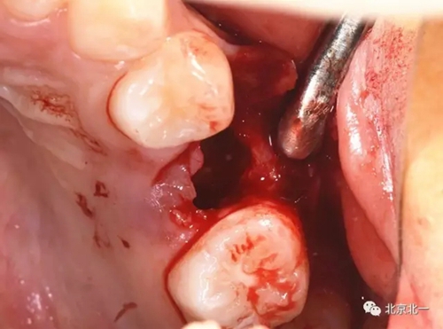 微創(chuàng)舒適拔埋伏牙病 微創(chuàng)舒適拔埋伏牙病