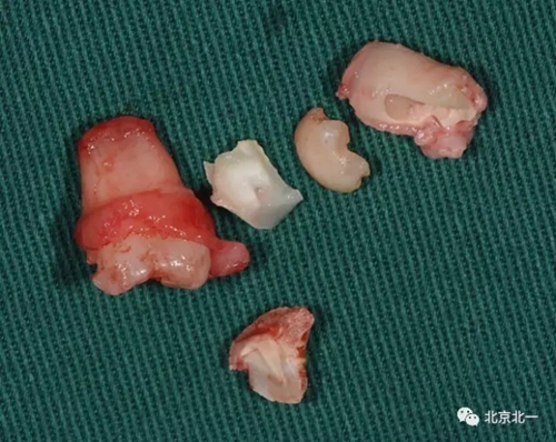 微創(chuàng)舒適拔埋伏牙病 微創(chuàng)舒適拔埋伏牙病