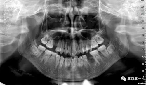 微創(chuàng)舒適拔埋伏牙病 微創(chuàng)舒適拔埋伏牙病