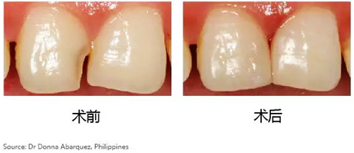 賀利氏 Opal 歐鉑樹脂 賀利氏 Opal 歐鉑樹脂