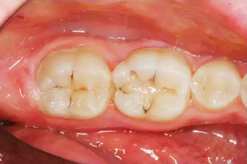 賀利氏 Opal 歐鉑樹脂 賀利氏 Opal 歐鉑樹脂