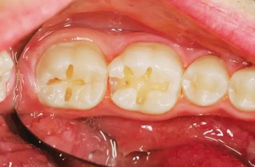 賀利氏 Opal 歐鉑樹脂 賀利氏 Opal 歐鉑樹脂