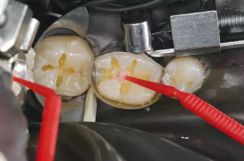 賀利氏 Opal 歐鉑樹脂 賀利氏 Opal 歐鉑樹脂