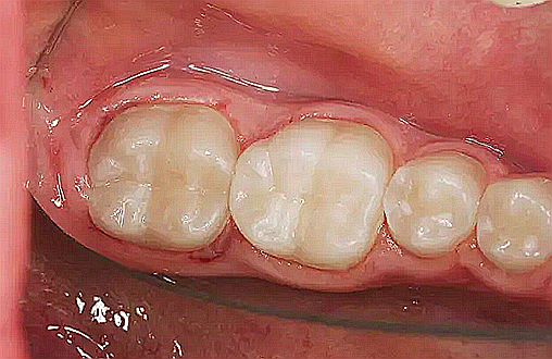 賀利氏 Opal 歐鉑樹脂 賀利氏 Opal 歐鉑樹脂