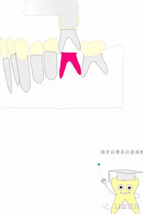 【愛牙科普知識300問】 “什么是活髓切斷術(shù)？”