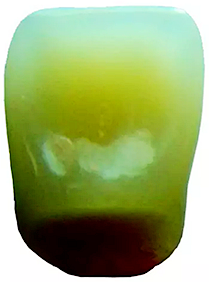 舌側(cè)釉質(zhì)層.png 舌側(cè)釉質(zhì)層.png