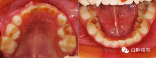 全麻下兒科治療+兒牙樹脂充填 全麻下兒科治療+兒牙樹脂充填