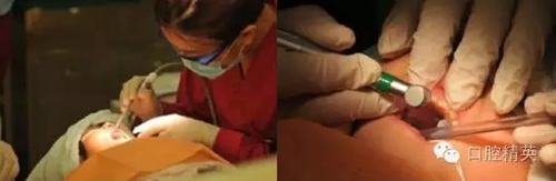 全麻下兒科治療+兒牙樹脂充填 全麻下兒科治療+兒牙樹脂充填