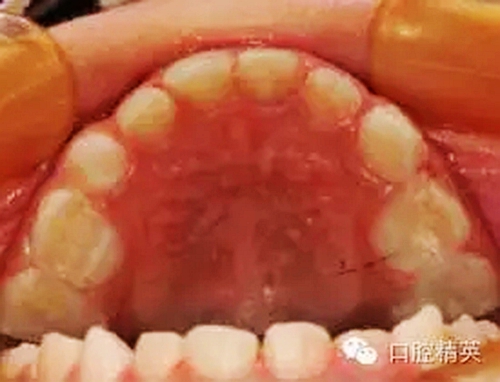 全麻下兒科治療+兒牙樹脂充填 全麻下兒科治療+兒牙樹脂充填