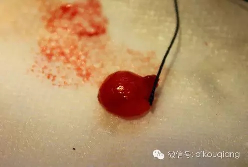 粘液腺囊腫 粘液腺囊腫